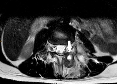 Figura 5. RM de columna vertebral: lesión lítica expansiva con nivel líquido (flecha) y pequeñas calcificaciones en su interior en arco posterior izquierdo de L3