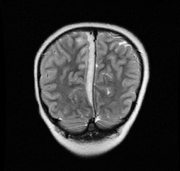 Figura 1. Empiema subdural. TC craneal: Colección extraaxial subdural en convexidad parafalciana derecha frontoparietal occipital de 5-6 mm de grosor, de contenido hipodenso sospechosa de empiema.