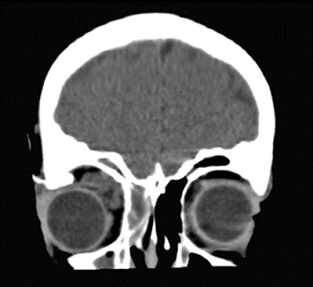 Figura 3. Colección intraorbitaria derecha. TC de órbita: colección de 2 cm de diámetro, intraorbitaria extraconal superolateral derecha, junto a glándula lagrimal; ocupación mucosa de seno frontal, maxilar y de celdillas etmoidales derechas.