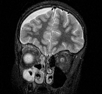 Figura 4. Absceso en región superomedial de la órbita derecha y empiema subdural derecho. TC de cráneo: empiema subdural frontal-parietal-temporal derecho con grosor máximo de 9 mm, que produce discreto efecto masa sin desplazamiento de la línea media; colección abscesificada en región superomedial de la órbita derecha, que ha aumentado de tamaño respecto a estudio previo; sinusitis derecha aguda.