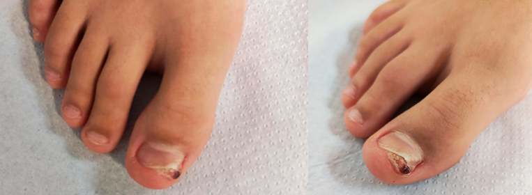 Figura 1. Tumoración subungueal hiperqueratósica con onicodistrofia localizada en la zona dorsomedial del primer dedo del pie derecho