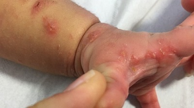 Figura 1. Lesiones papulosas y pustulosas en mano y antebrazo excoriadas e impetiginizadas. 