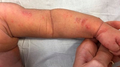 Figura 2. Lesiones papulosas y pustulosas en mano y antebrazo, con lesiones de rascado asociadas.