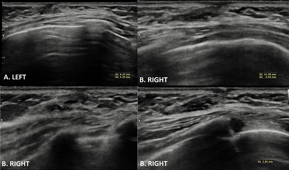 Figura 2. Ecografía mamaria. A. Mama izquierda. B. Mama derecha. Ambas mamas muestran imágenes hipoecogénicas retroareolares compatibles con ectasia ductal mamaria.