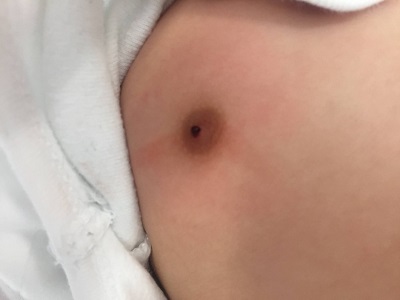 Figura 1. Sangrado (telorragia) por el pezón derecho en un lactante de 5 meses de edad.