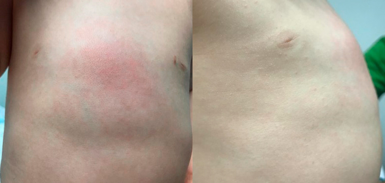 Figura 1. Tumoración esternal visualizada en la exploración física