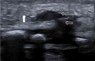 Figura 2. Ecografía de partes blandas. Corte longitudinal utilizando sonda lineal de alta frecuencia. Se observa una tumoración ovalada localizada en el tejido celular subcutáneo (flecha larga) de la región preesternal. Dicha tumoración se origina de los núcleos de osificación esternales inferiores (flecha corta). Esta imagen corresponde a la morfología en pesa. También se observa moderada hiperecogenicidad de la grasa subcutánea (flecha rellena) compatible con cambios inflamatorios