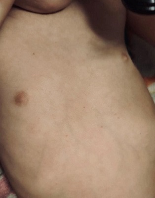 Figura 1. Lactante con exantema petequial creciente