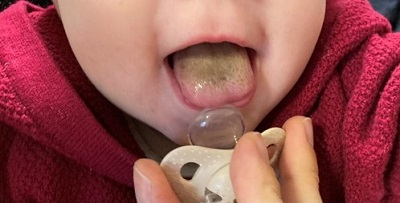 Figura 1. Lengua vellosa negra en lactante de 6 meses