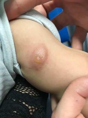 Figura 1. Lactante con lesión cutánea hiperpigmentada, ovalada, de superficie irregular y aproximadamente 1 cm de diámetro en la cara interna del miembro superior izquierdo