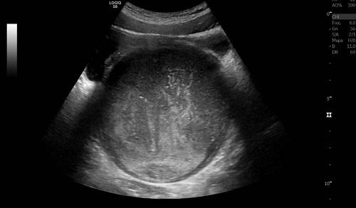 Figura 1. Imagen ecográfica de la masa compatible con hematocolpos