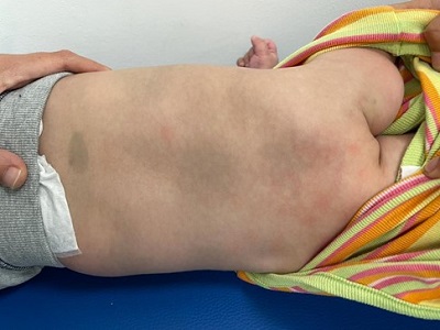 Figura 1. Lactante con manchas azuladas en región lumbosacra