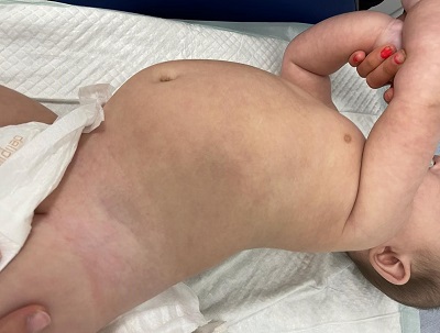 Figura 2. Mancha de gran extensión en región dorsal de bordes muy poco definidos e irregulares que se extiende hacia el tórax anterior ocupando el hipocondrio izquierdo