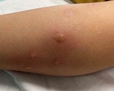 Figura 1. Lesiones vesiculosas en miembro inferior izquierdo 