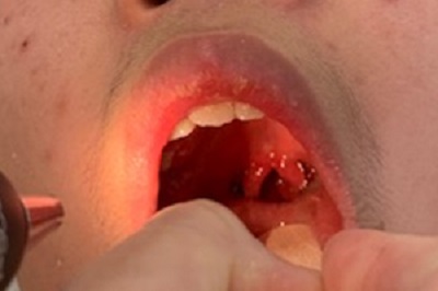 Figura 1. Úvula bífida y coloración azul grisácea en el centro del paladar blando