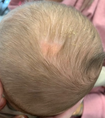 Figura 1. Nevo sebáceo: placa alopécica engrosada de color asalmonado 