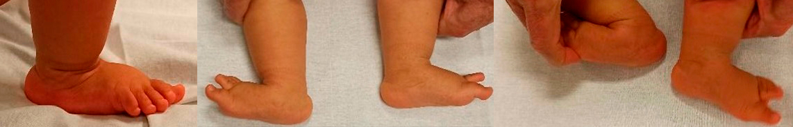 Figura 1. Pie derecho plano valgo talo reductible parcialmente