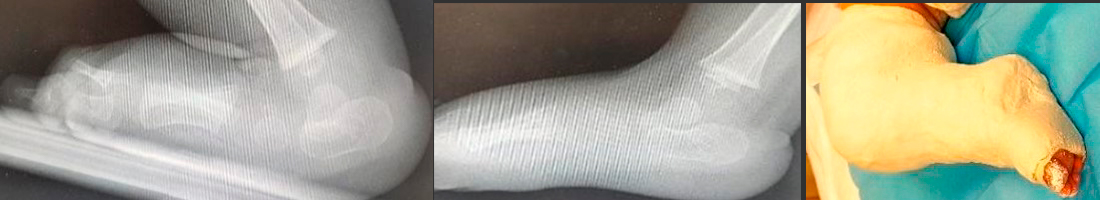 Figura 2. En la radiografía se observa astrágalo vertical derecho que se muestra subluxado (izquierda). Pie izquierdo normal (centro). Se coloca yeso con recambio semanal (derecha).