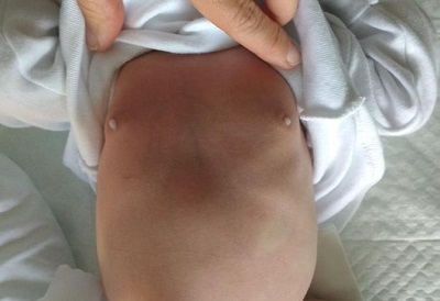 Figura 1. Neonata de 9 días con induración de ambas mamas y leve eritema