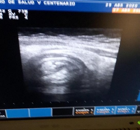 Figura 1. Ecografía abdominal