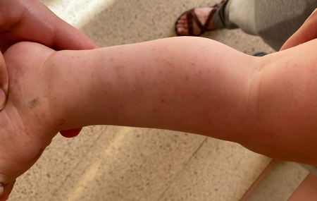 Figura 1. Lesiones micropapulopustulosas