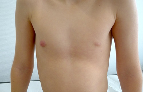 Figura 1. Lesión en areola mamaria