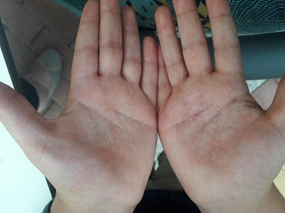 Figura 1. Lesiones papulosas blanquecinas confluentes en palmas