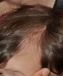 Figura 1. Alopecia triangular congénita