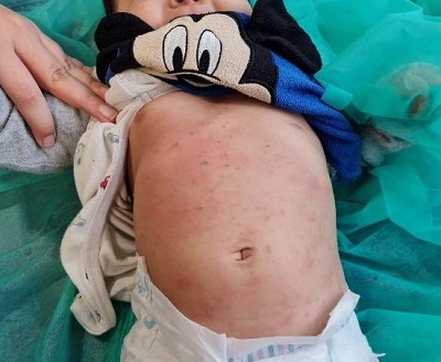 Figura 2. Erupción cutánea pruriginosa