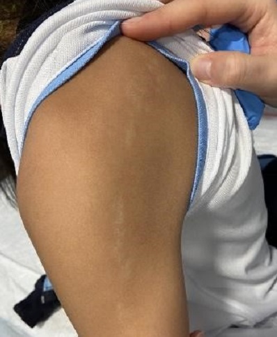 Figura 3. Lesiones papulares e hipopigmentadas