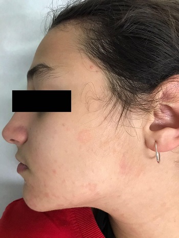 Figura 1. Patologías cutáneas en la zona facial debido al uso de mascarillas.