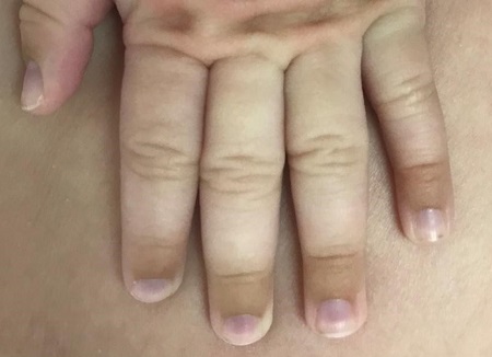 Figura 1. Coloración marronácea en las falanges distales de las manos del lactante.