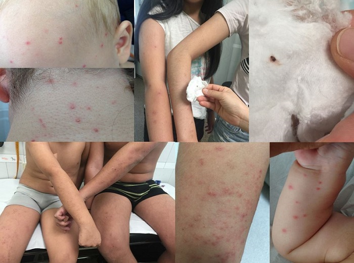 Figura 1. Lesiones micropapulares, eritematosas y pruriginosas, algunas de distribución lineal o bien agrupadas, pero casi siempre múltiples, no confluyentes, en zonas de exposición directa a la ropa de cama como cara, cuello, brazos y piernas. Presentes en varios miembros de la familia. Imagen superior derecha: Chinche de cama (Cimex lectularius).