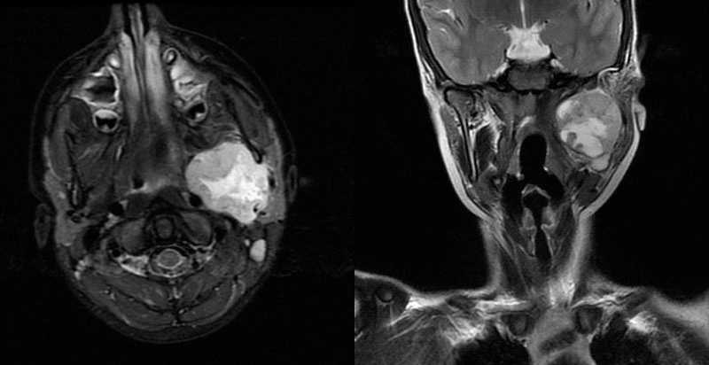 Figura 1. RM cerebral-cervical. Plano coronal y transversal. 