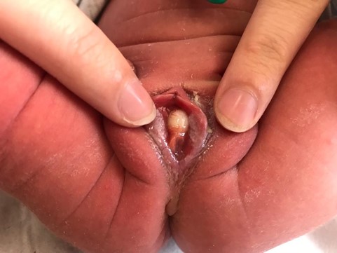 Figura 1. Quiste parauretral del conducto de Skene. 