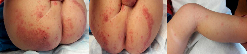 Figura 1. Eccema coxsakium