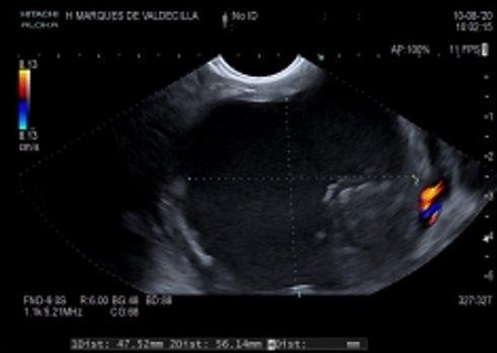 Figura 1. Colección peripancreática visualizada mediante ecoendoscopia