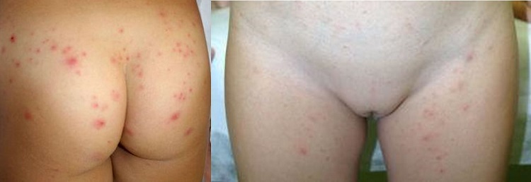 Figura 1. Lesiones papulopustulosas eritematosas
