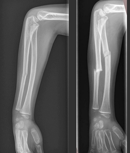 Figura 1. A la izquierda, fractura diafisaria de cúbito derecho (07/2021). A la derecha, fractura diafisaria de cúbito y radio derechos (09/2021).
