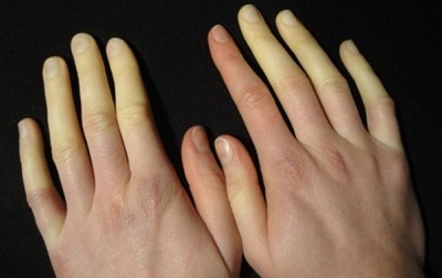 Figura 1. Imagen de los episodios de palidez que presenta nuestro paciente en relación con el frío. 