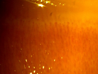 Figura 2. Capilaroscopia en la que no se observan alteraciones que sugieran patología reumática. 