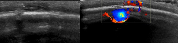 Figura 1. A la izquierda se visualiza imagen nodular, bien delimitada de morfología ovoidea. A la derecha se detecta la hiperseñal Doppler de la lesión.