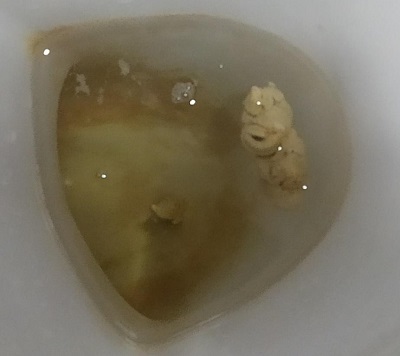 Figura 1. Heces acólicas