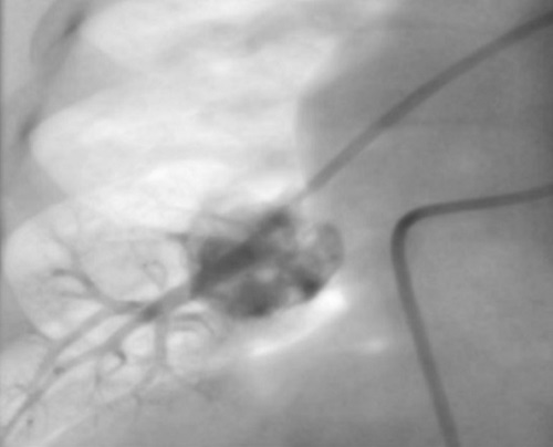 Figura 3. Principales imágenes radiológicas del caso: fluoroscopia al diagnóstico