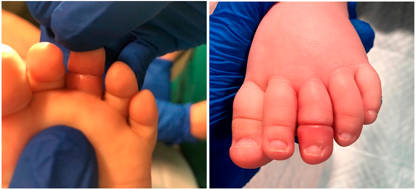 Figuras 1 y 2. Enrojecimiento y edema de la parte distal al estrangulamiento por un cabello enrollado en el dedo del pie. 