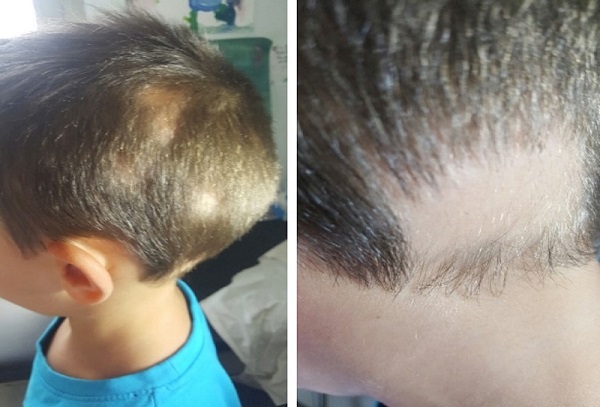 Figura 1. Alopecia areata en placas de disposición ofiásica.