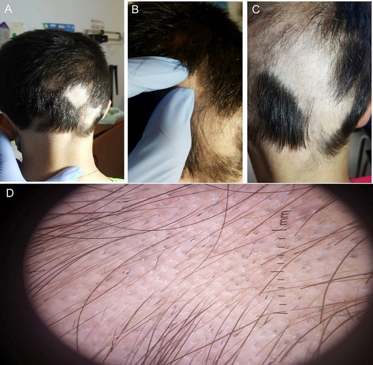 Figura 2. Alopecia areata en placas de disposición ofiásica. (D): tricoscopia con abundantes folículos pilosos con puntos negros, pelos rotos y otros con morfología de signos de admiración.