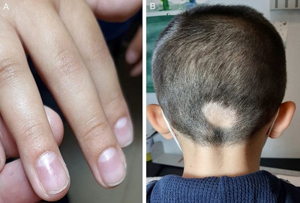 Figura 3. (A): piqueteado ungueal irregular. (B): placa alopécica única occipital con signos de actividad.