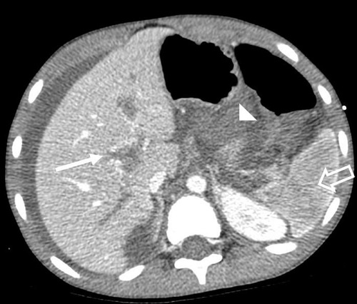 Figura 2. Imagen de TC abdominopélvica con contraste intravenoso en fase portal, corte axial, donde se identifica ausencia de repleción de la vena porta y sus ramas (flecha fina) compatible con trombosis. Además, se aprecia ausencia de realce de la práctica totalidad del parénquima esplénico, sugerente de infarto esplénico venoso (flecha hueca). Se observan asas intestinales en compartimento supramesocólico con ausencia de realce tras la administración de contraste intravenoso, sugerente de proceso isquémico de etiología venosa (cabeza de flecha).