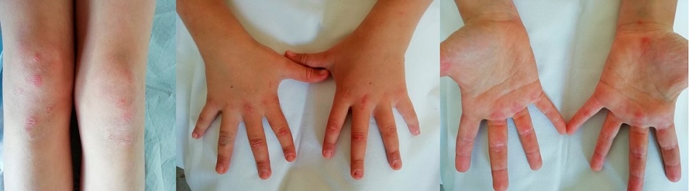 Figura 1. RM de miembros inferiores que revela datos de edema muscular en la región proximal de ambos miembros inferiores, especialmente en el cuádriceps izquierdo